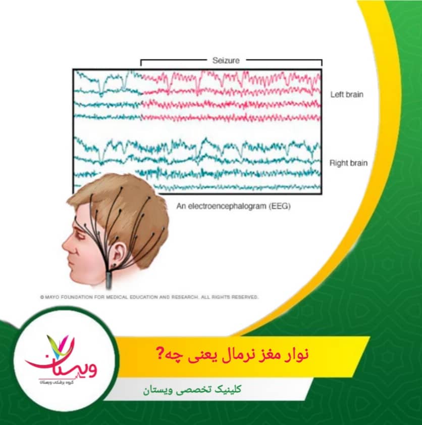 داشتن نوارمغز نرمال به معنای نبودن فعالیتهای غیرطبیعی در زمان ثبت است. نوار مغز نرمال یعنی چه؟