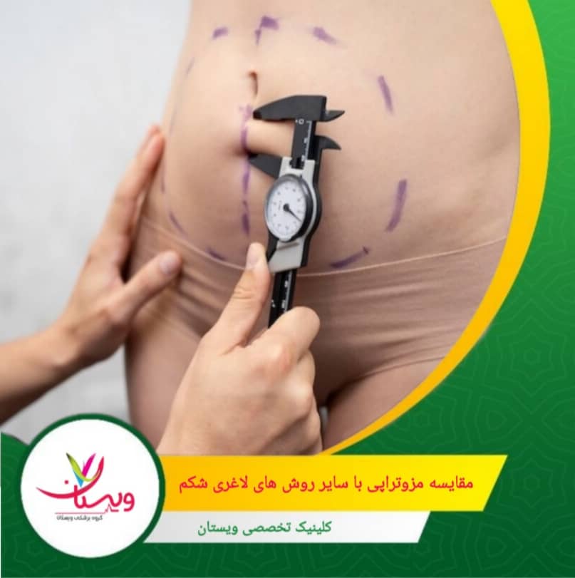 کاهش چربی موضعی و بهبود پوست از مزایای مزوتراپی برای لاغری شکم می باشد. مقایسه مزوتراپی با سایر روشهای لاغری شکم