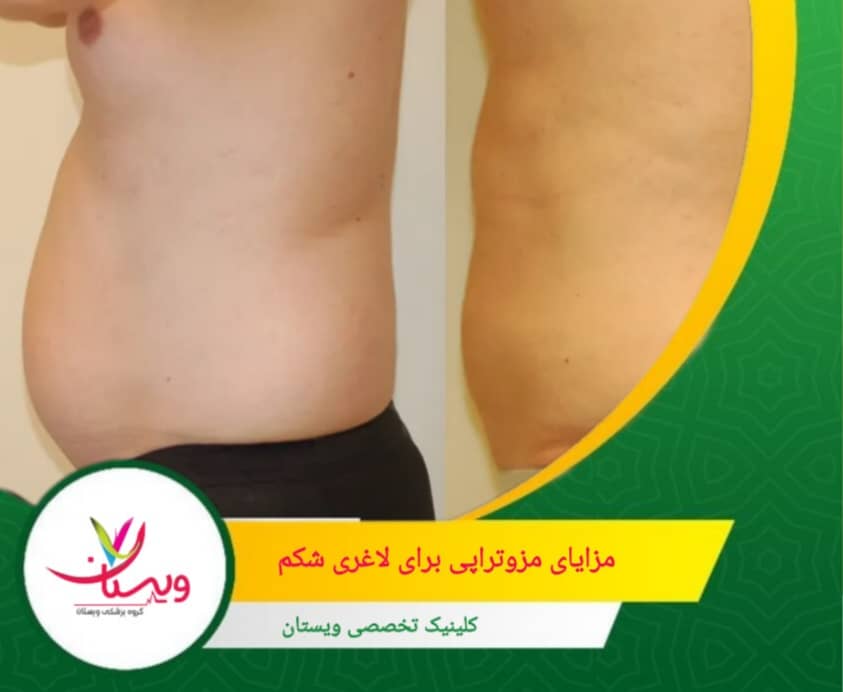 مواد تزریقی، مانند فسفاتیدیلکولین و دئوکسیکولیک اسید، دیواره سلولهای چربی را تخریب میکنند و محتویات آنها را آزاد میسازند. مزایای مزوتراپی برای لاغری شکم