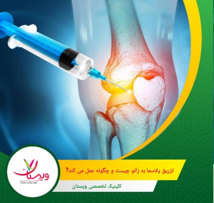 پلاکتها حاوی پروتئینها و فاکتورهای رشدی هستند که نقش مهمی در فرآیندهای ترمیمی بدن دارند. تزریق پلاسما به زانو چیست و چگونه عمل میکند؟
