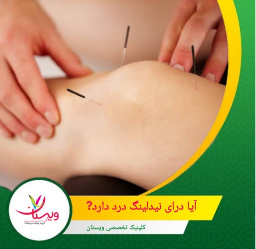 بیشتر بیماران پس از درمان کاهش درد و آرامش عضلانی را گزارش میکنند. کمی حساسیت یا کوفتگی بعد از جلسه طبیعی است و نشانه شروع بهبودی است. آیا درای نیدلینگ درد دارد؟