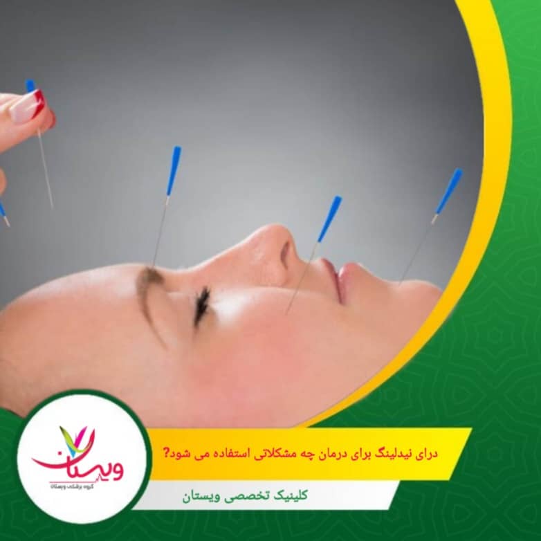 کاهش حساسیت و تنش در نواحی تحت فشار عضلات. درای نیدلینگ برای درمان چه مشکلاتی استفاده میشود؟
