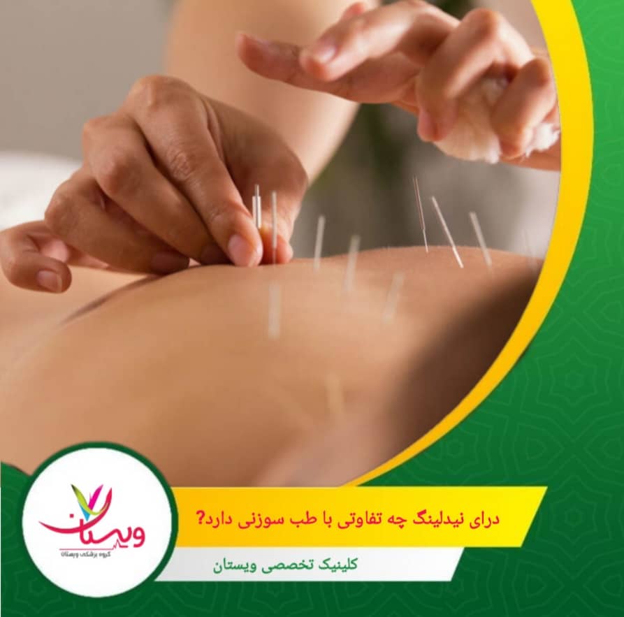 اگر به دنبال درمان کلنگرانه برای تعادل ذهن و جسم هستید، طب سوزنی میتواند مناسب باشد. درای نیدلینگ چه تفاوتی با طب سوزنی دارد؟