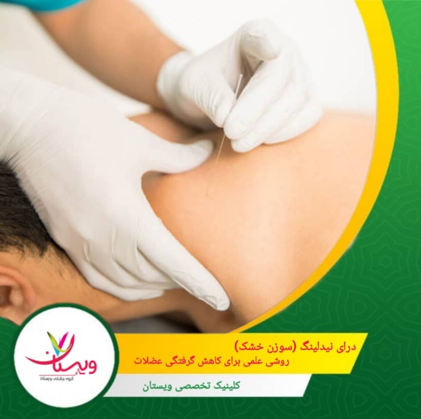 درای نیدلینگ (سوزن خشک)، روشی علمی برای کاهش گرفتگی عضلات