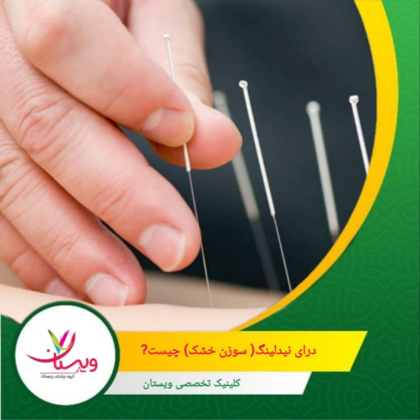 درای نیدلینگ (Dry Needling) یا سوزن خشک یک روش درمانی نوین در فیزیوتراپی است که با استفاده از سوزنهای بسیار نازک، بدون تزریق مادهای به بدن، عضلات دردناک و منقبض را هدف قرار میدهد. درای نیدلینگ (سوزن خشک) چیست؟