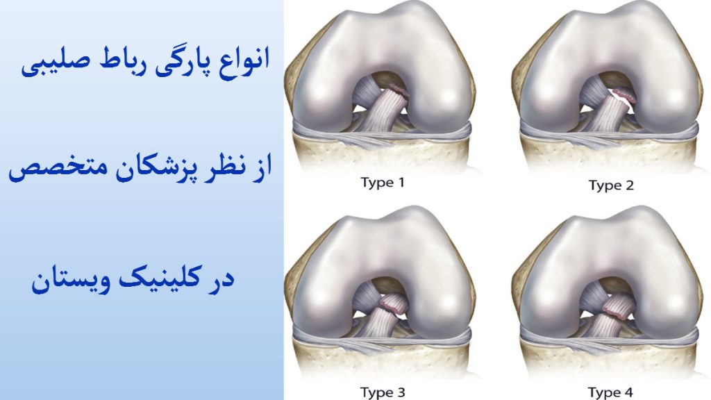 انواع پارگی رباط صلیبی چهار تصویر از انواع پارگی رباط صلیبی در یک قاب با پس زمینه آبی