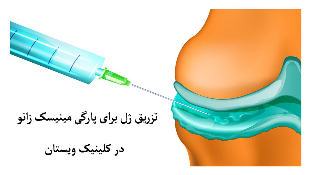 تزریق ژل به زانو برای پارگی مینیسک یک سرنگ در حال تزریق به مینیسک زانو