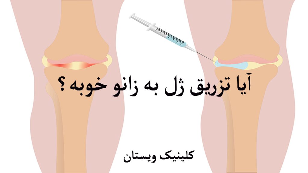 تزریق ژل برای زانو پاهای یک شخص که به یکی از زانو ها ژل تزریق می شود