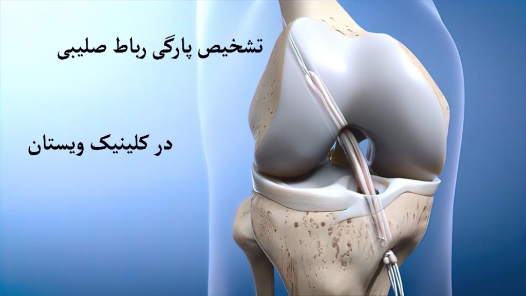 تشخیص پارگی رباط صلیبی مفصل زانو و پارگی رباط صلیبی