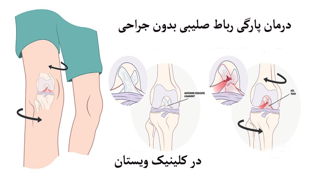 چند تصویر از زانوی پای انسان که دچار پارگی رباط صلیبی شده است
