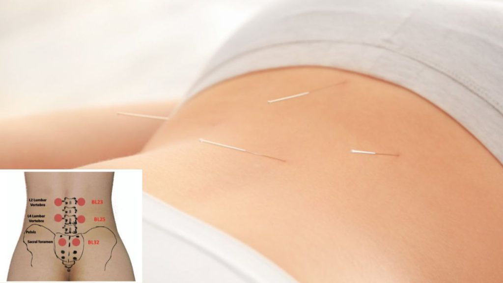 طب سوزنی برای درمان درد دنبالچه