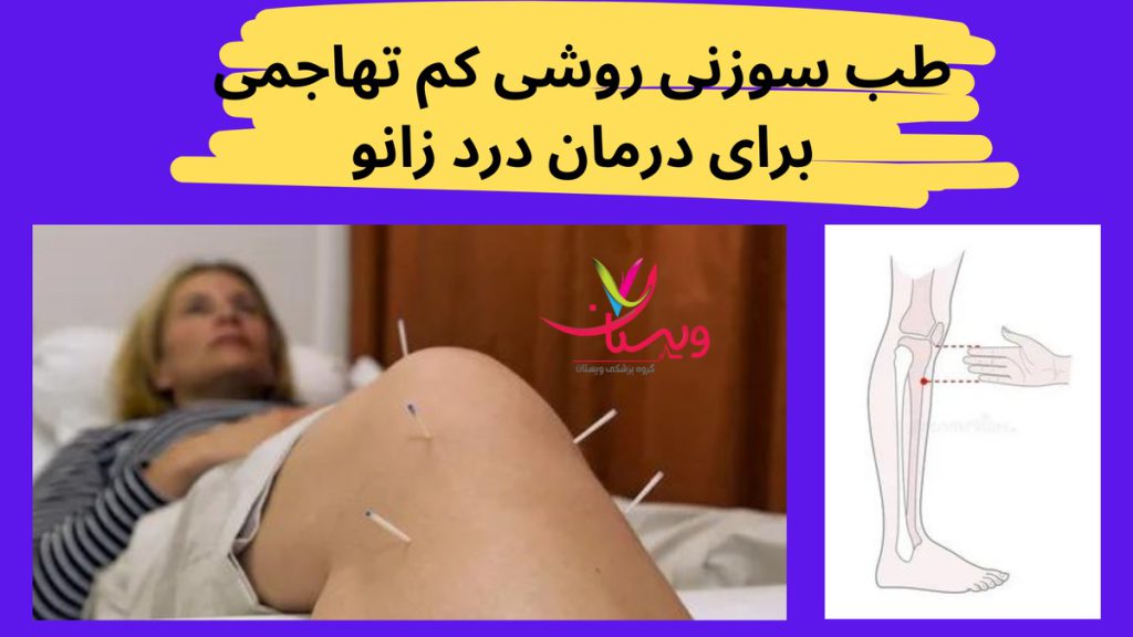 آسیبهای زانو طب سوزنی روشی کم تهاجمی برای درمان درد زانو