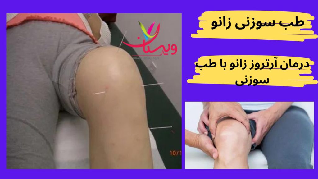 مشکلات زانو طب سوزنی زانو چیست