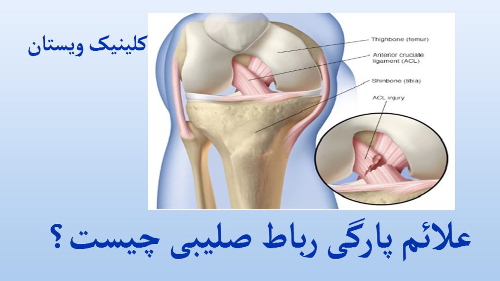 علائم پارگی رباط صلیبی زانوی انسان و تصویری زوم شده از پارگی رباط آن