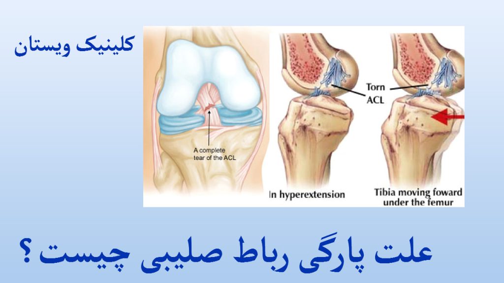 علت پارگی رباط صلیبی سه تصویر از مفصل زانوی انسان