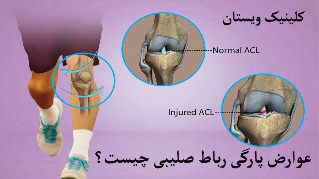 عوارض پارگی رباط صلیبی یک شخص که زانوی او به طور مشخص برای نمایش پارگی رباط صلیبی با فلش مشخص شده است