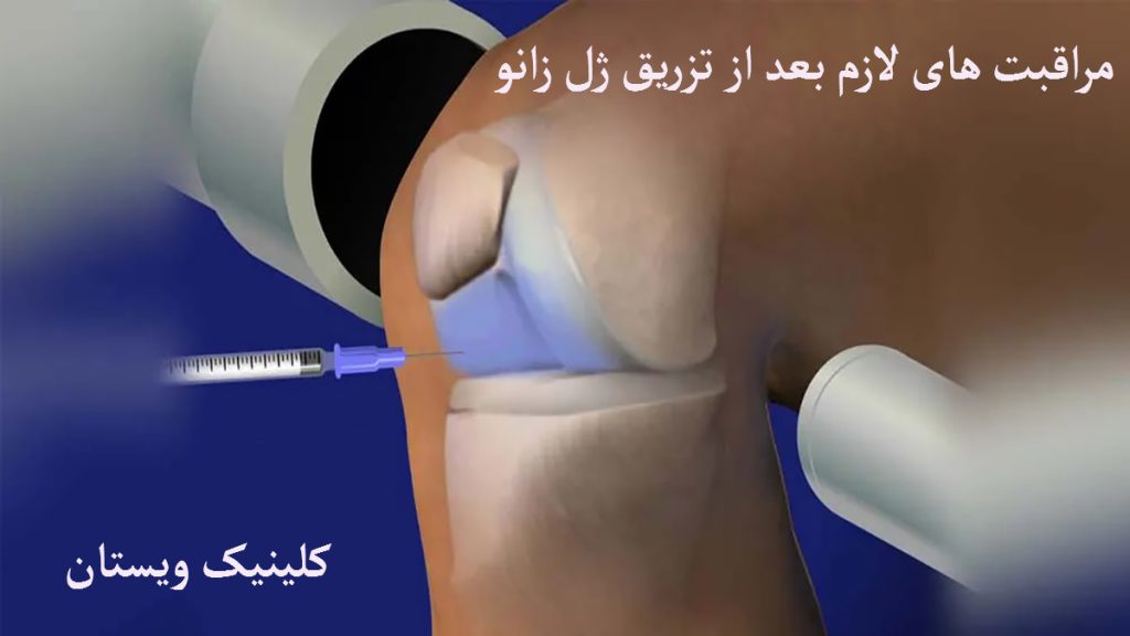 مراقبت بعد از تزریق ژل زانو یک تصویر انیمیشنی از تزریق ژل به زانو