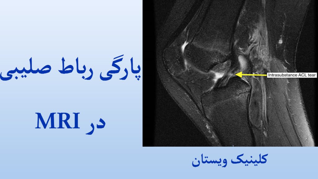 MRI پارگی رباط صلیبی گرافی ام آر آی از زانو انسان و پارگی رباط آن