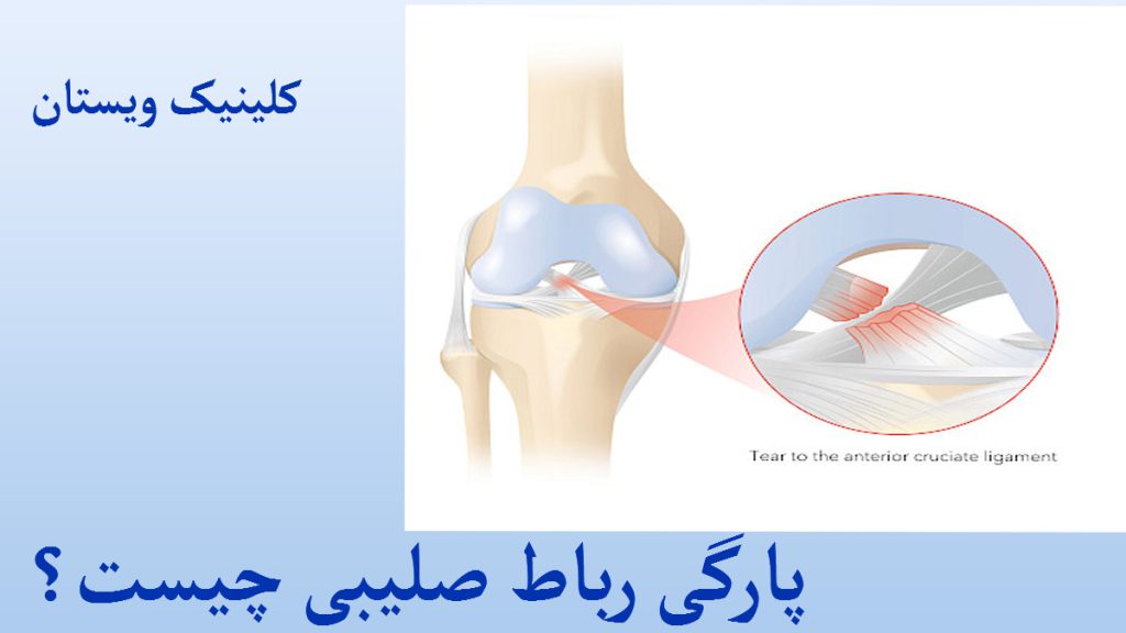 پارگی رباط صلیب یک استخوان پا به همراه مفصل زانو و نوشته ای درباره پارگی رباط صلیبی چیست؟