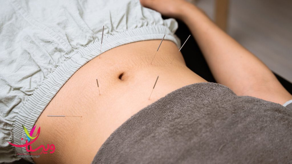 انجام طب سوزنی شکم فردی در حال انجام طب سوزنی