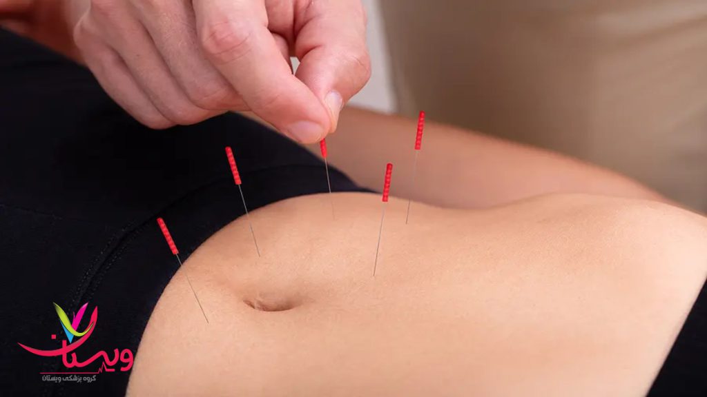 متخصص در حال طب سوزنی برای لاغری شکم انجام طب سوزنی برای لاغری