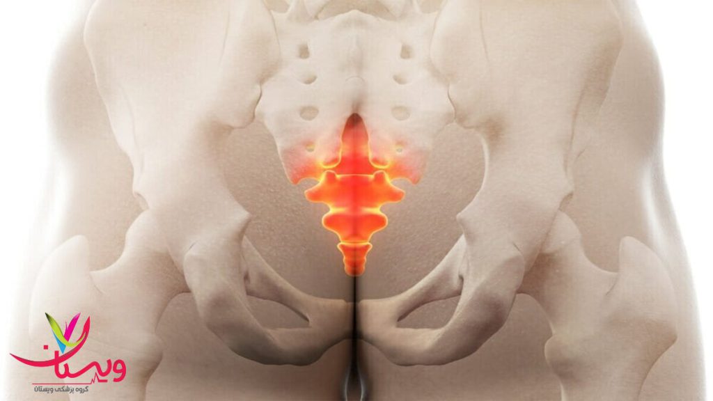 بروز درد دنبالچه بیماری که دچار درد دنبالچه شده است