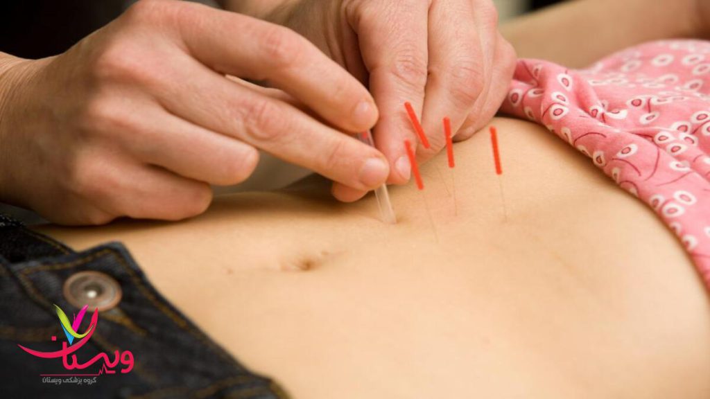 متخصص برای بیمار طب سوزنی انجام می دهد استفاده از طب سوزنی برای بیمار توسط پزشک