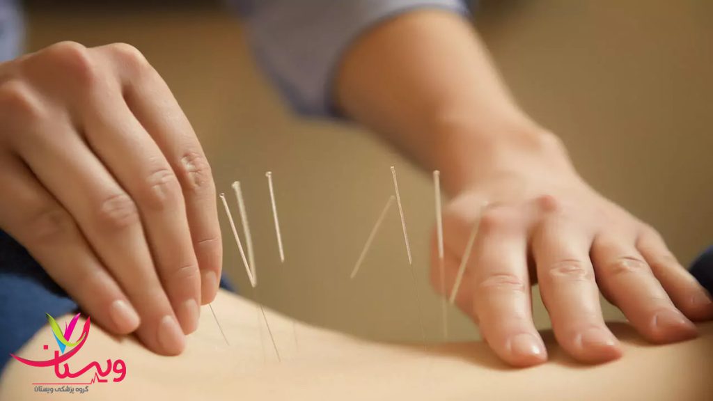 درمان دردهای دنبالچه با طب سوزنی انجام طب سوزنی برای درمان دنبالچه توسط متخصص