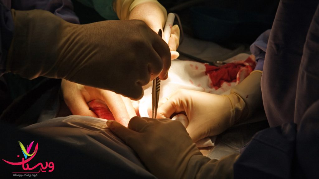 انجام جراحی برای درمان دیسک کمر خطرناک پزشک جراح در حال جراحی دیسک کمر