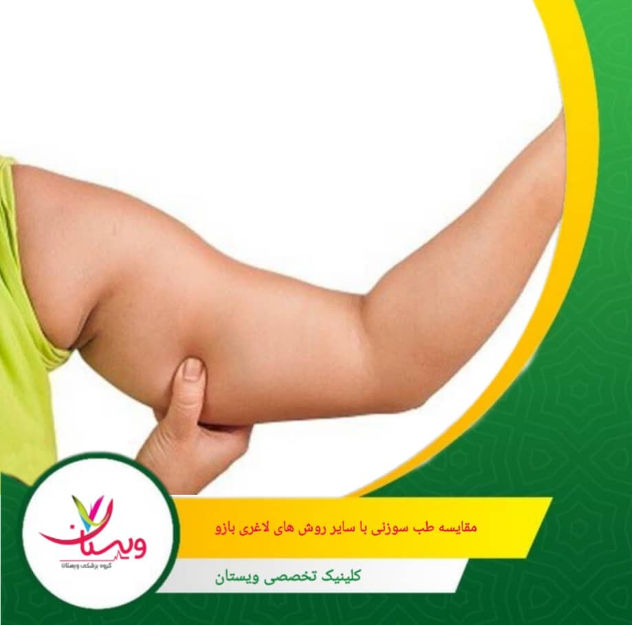 لیپوساکشن، گزینهای مناسب برای حذف چربیهای مقاوم به رژیم و ورزش. مقایسه طب سوزنی با سایر روشهای لاغری بازو
