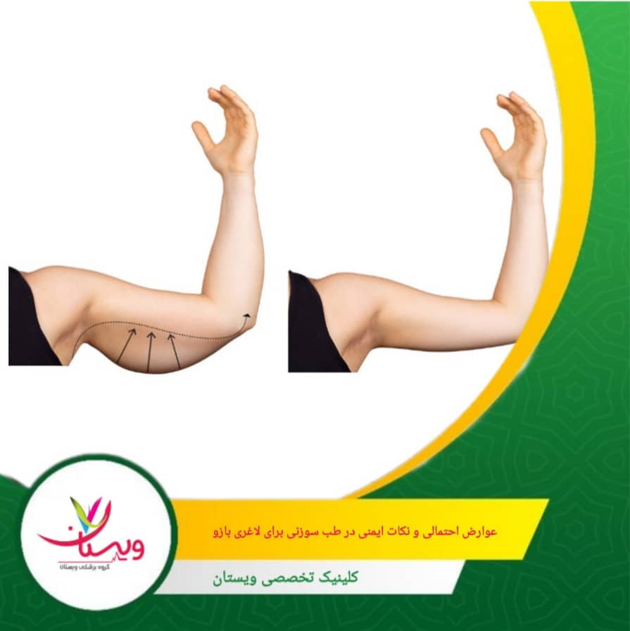 اگر سوزنها به درستی استریل نشوند، احتمال عفونت محل ورود سوزن وجود دارد. عوارض احتمالی و نکات ایمنی در طب سوزنی برای لاغری بازو