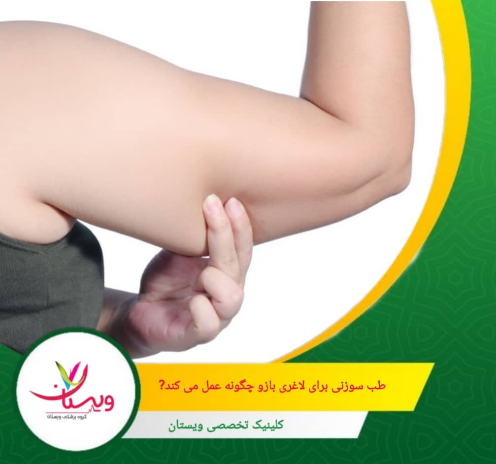طب سوزنی با افزایش سطح اندورفین و سروتونین در مغز، به کاهش استرس و بهبود کیفیت خواب کمک میکند. طب سوزنی برای لاغری بازو چگونه عمل میکند؟