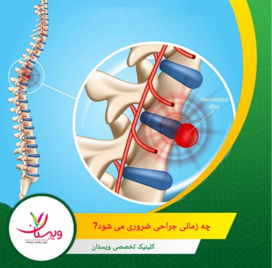 جراحی پارگی دیسک کمر زمانی ضروری میشود که درمانهای غیرجراحی درد و علائم را کنترل نکنند و فشار دیسک روی عصبها باعث ضعف عضلانی، بیحسی شدید یا مشکلات کنترل ادرار و مدفوع شود. چه زمانی جراحی ضروری می شود؟