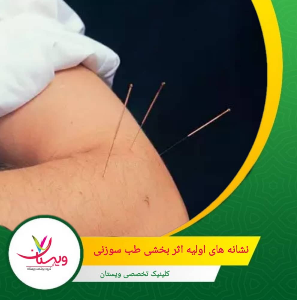 در حین یا پس از جلسه، ممکن است احساس سنگینی، بیحسی یا فشار ملایم در نقاط خاصی از بدن تجربه شود. نشانههای اولیه اثربخشی طب سوزنی