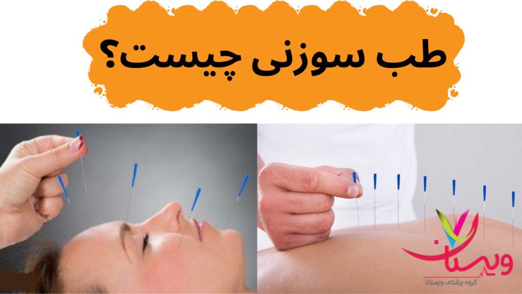 طب سنتی چینی طب سوزنی چیست