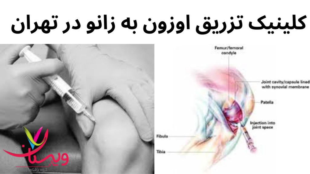 اوزون تراپی زانو کلینیک تزریق اوزون به زانو در تهران