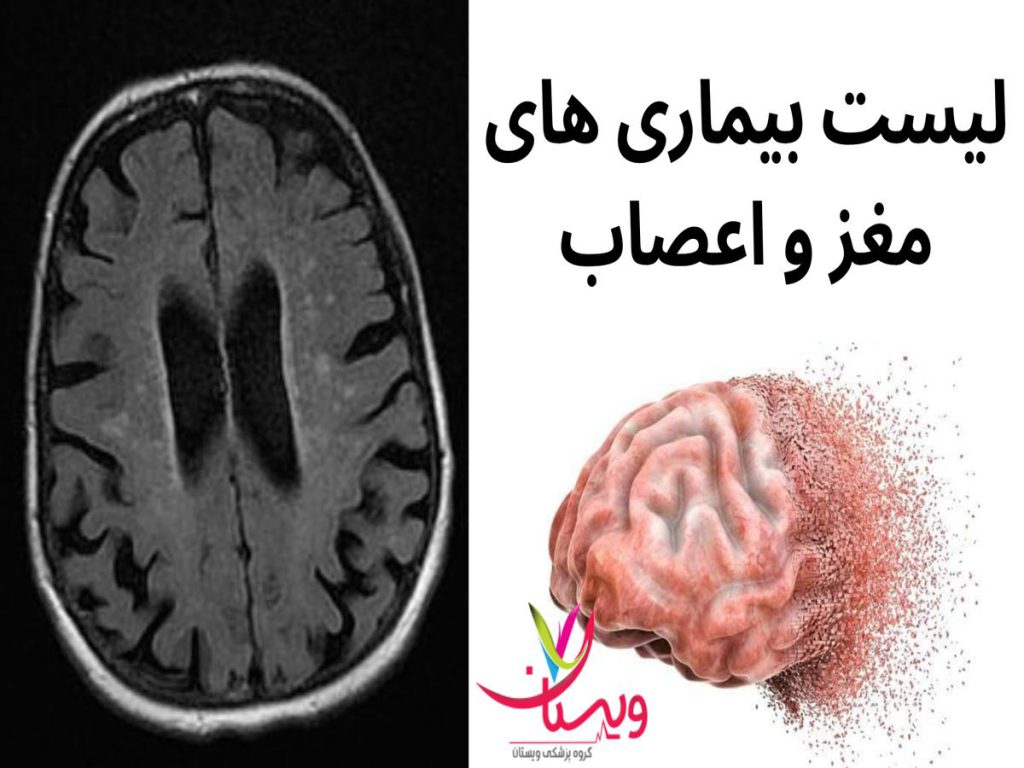 متداولترین بیماری مغز و اعصاب لیست رایج ترین بیماری مغز و اعصاب