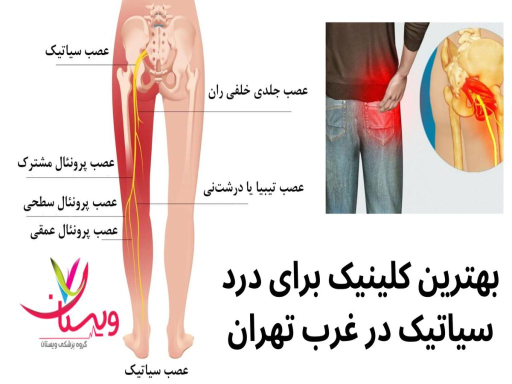 خدمات کلینیک ویستان بهترین کلینیک برای درد سیاتیک در غرب تهران
