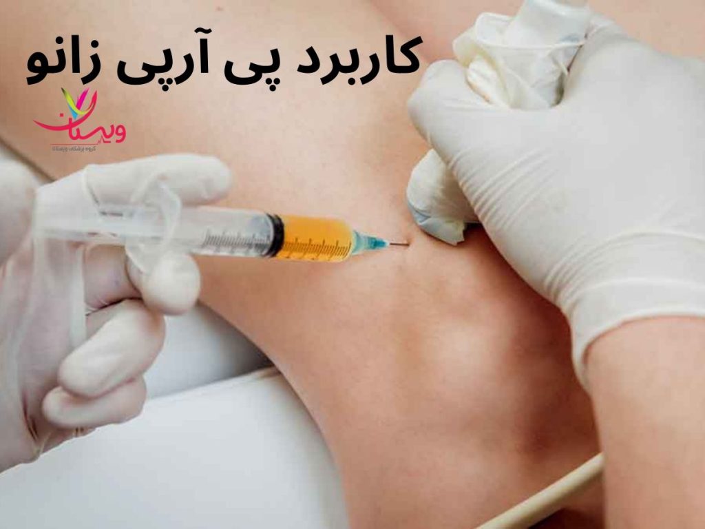 درمان پارگی و التهاب مینیسک زانو با prp کاربرد prp زانو