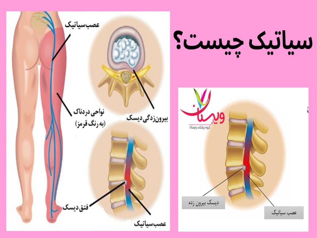 تحریک عصب سیاتیک سیاتیک چیست