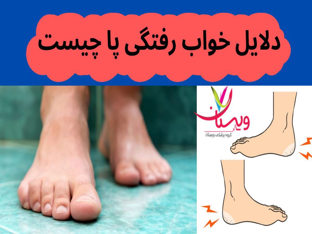 بیحسی یا ضعف در ناحیه پا دلایل خواب رفتگی پا چیست