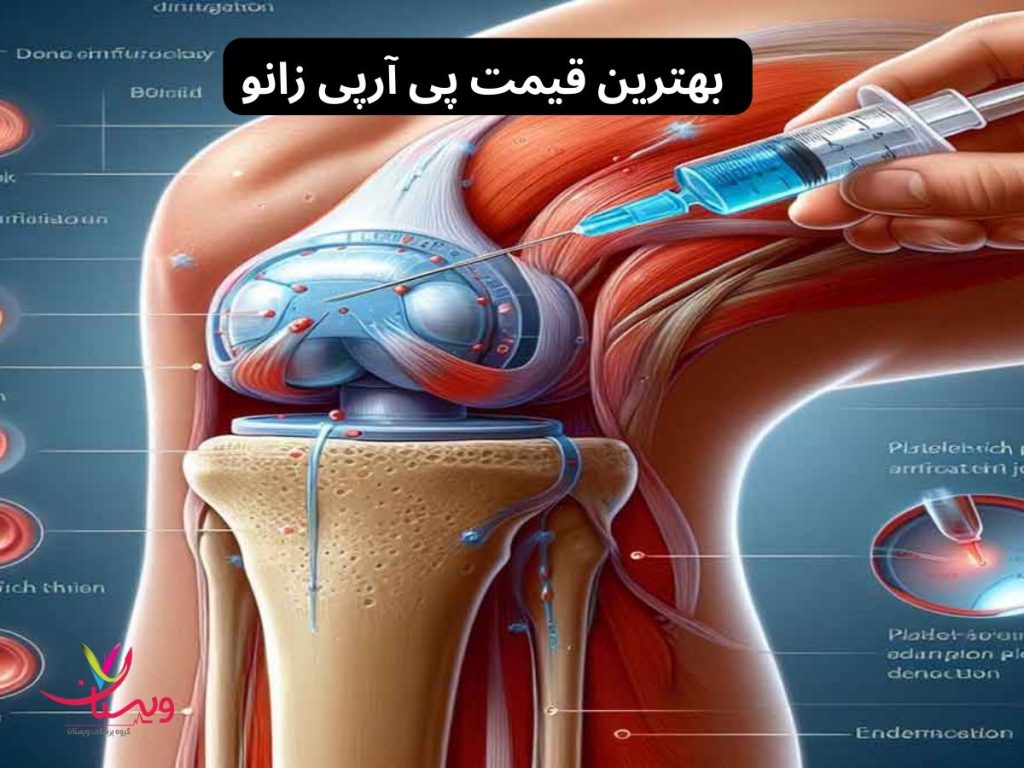 درمان زانو درد با prp بهترین قیمت پی آر پی زانو در تهران