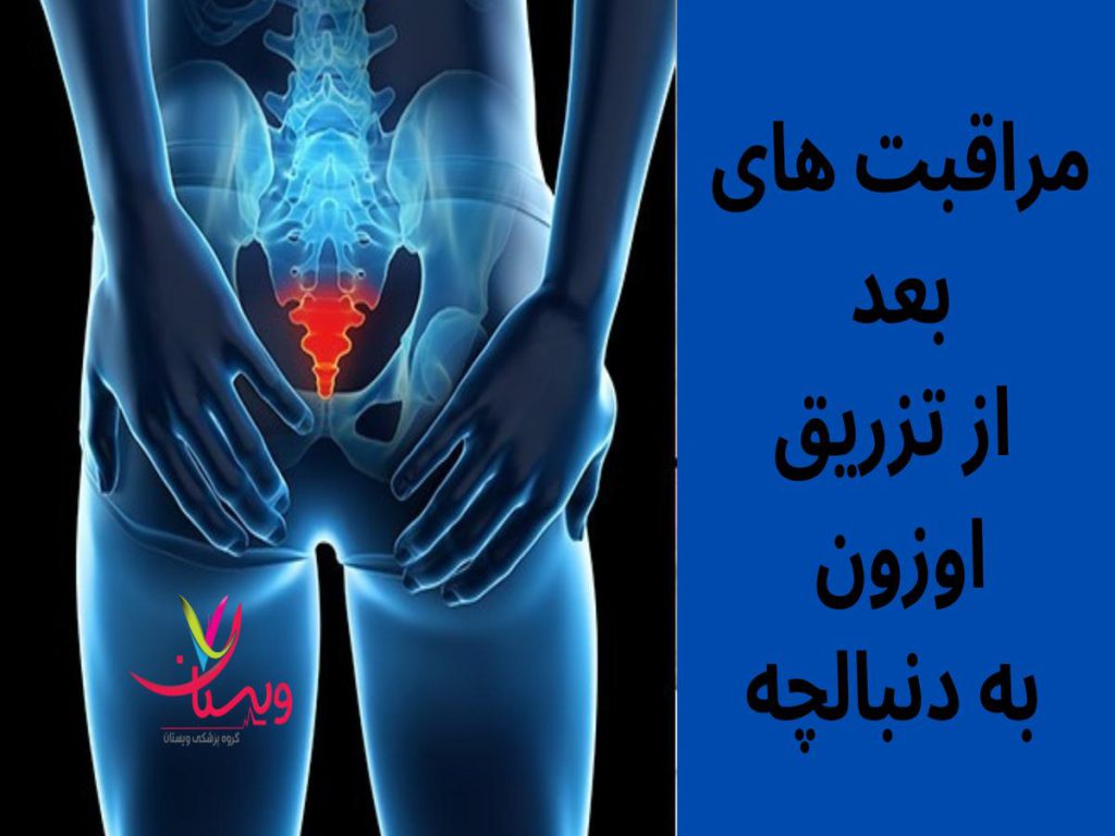 اجتناب از فعالیتهای شدید مراقبت های بعد از تزریق اوزون به دنبالچه