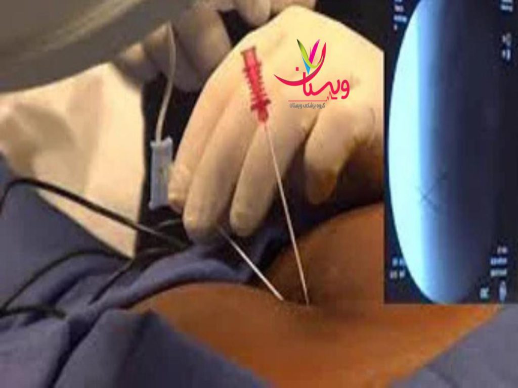 التهابهای ناحیه کمر اوزونتراپی