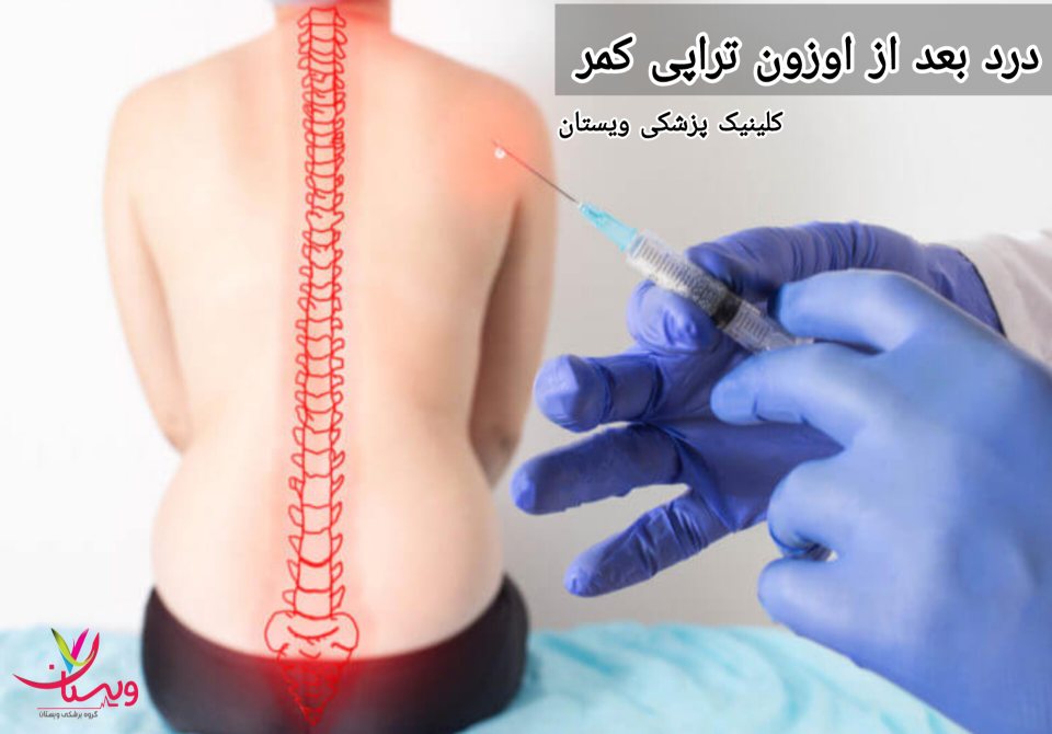اگر درد به شدت احساس شود یا به مدت طولانی ادامه یابد، توصیه میشود با پزشک خود مشورت کنید. درد بعد از اوزون تراپی کمر