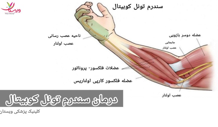 انتقال عصب اولنار: که در آن عصب به موقعیت جدیدی منتقل میشود تا فشار بر روی آن کاهش یابد. درمان سندرم تونل کوبیتال