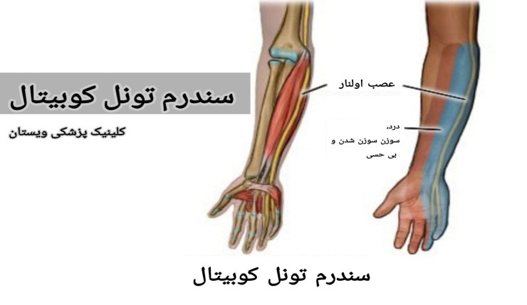 برخی افراد نیز به طور طبیعی دارای دالان کوبیتال باریکی هستند که احتمال بروز این مشکل را افزایش میدهد. سندرم تونل کوبیتال