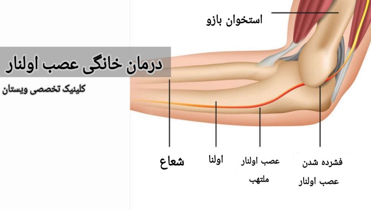 از حرکات مکرر و خم کردن آرنج خودداری کنید و سعی کنید آرنج را در وضعیت صاف نگه دارید. درمان خانگی عصب اولنار