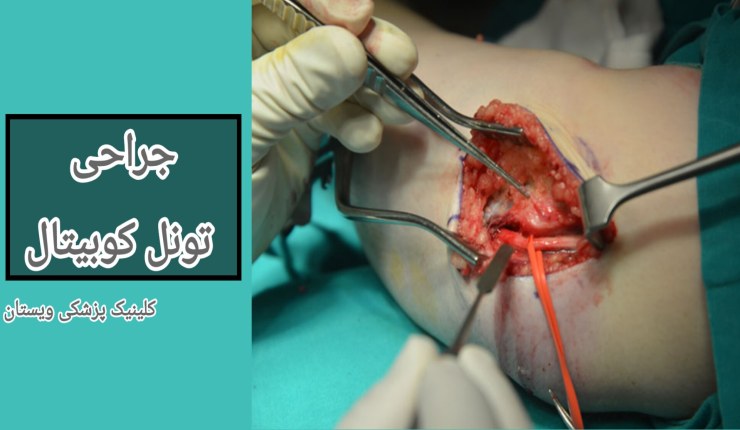 پس از انجام جراحی، مراقبتهای بعد از عمل شامل استراحت مناسب، استفاده از آتل و انجام تمرینات فیزیوتراپی است. جراحی تونل کوبیتال