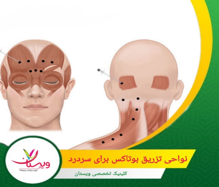 انتخاب نواحی تزریق باید با دقت و بر اساس ارزیابیهای پزشکی انجام شود تا بهترین نتیجه ممکن حاصل شود و از بروز عوارض جانبی جلوگیری گردد. نواحی تزریق بوتاکس برای سردرد